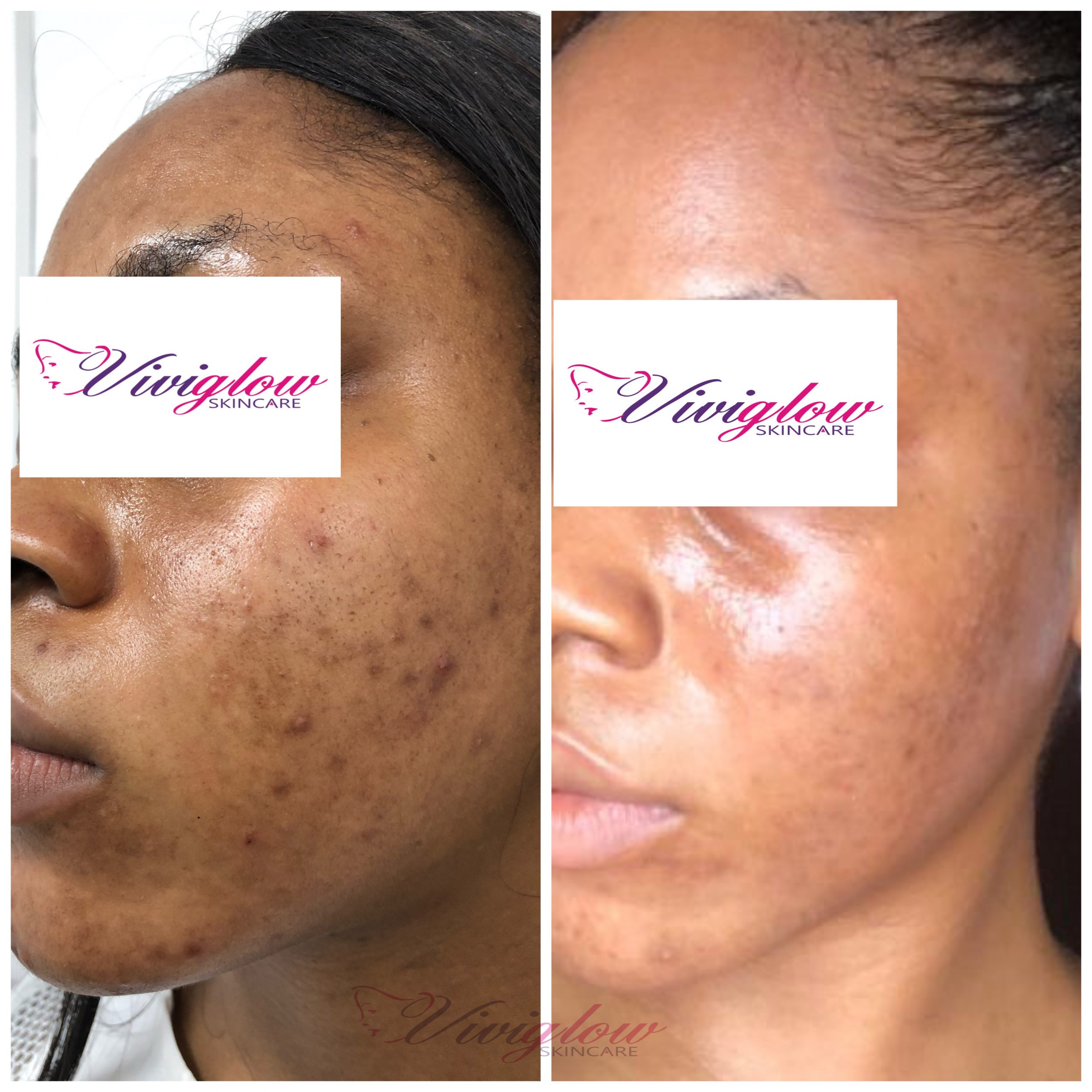 Skincare transformations - Vhueskin