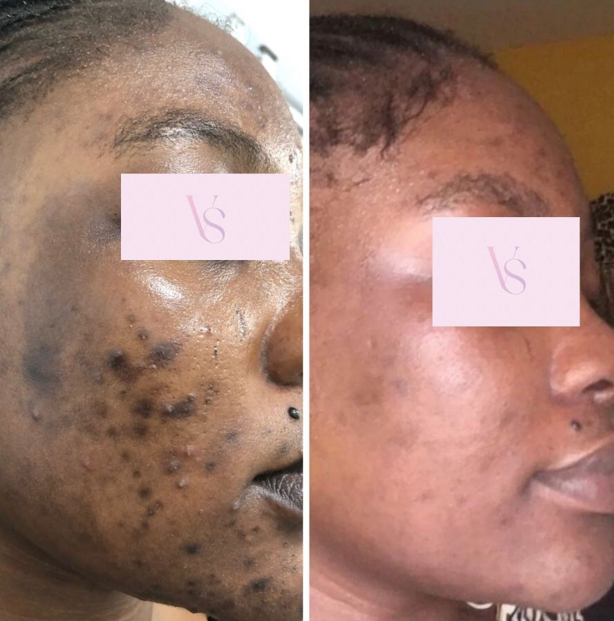 How To Fade Dark Spots Hyperpigmentation Vhueskin